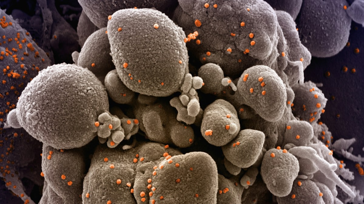 Novel Coronavirus SARS-CoV-2 Colorized scanning electron micrograph of an apoptotic cell (tan) infected with SARS-COV-2 virus particles (orange), isolated from a patient sample. Image captured at the NIAID Integrated Research Facility (IRF) in Fort Detrick, Maryland. Credit: NIAID https://www.flickr.com/photos/niaid/49679608176/